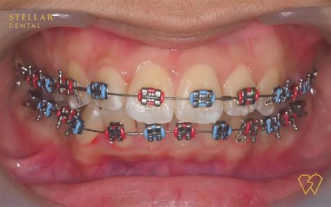 Braces Colors: Top Picks For 2023 - Stellar Dental