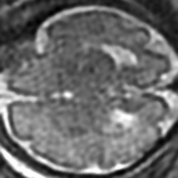 MRI picture of lissencephaly. | Download Scientific Diagram