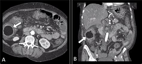 Cureus | Cecal Lipoma: A Rare Etiology of Acute Appendicitis in Adults