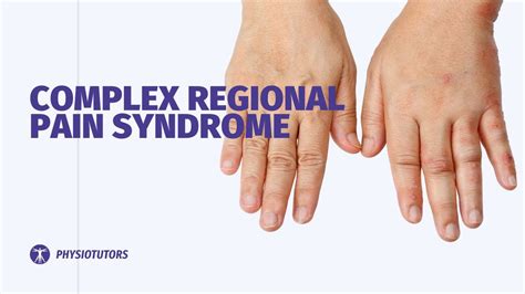 Complex Regional Pain Syndrome (CRPS): Causes Symptoms, 48% OFF