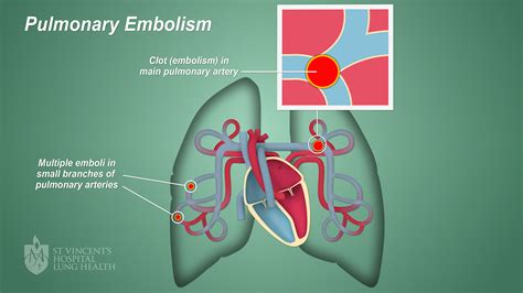 Pulmonary Embolism Types