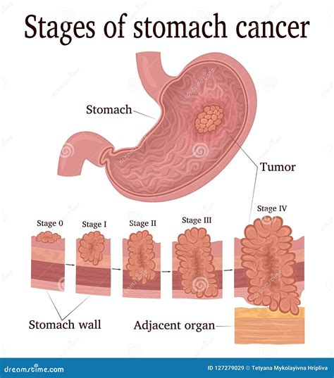 Stages Of Cancer. Classification Of Malignant Tumours Cartoon Vector ...