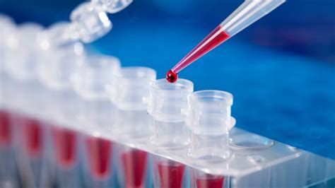 Vein-Finder-Assisted Serology Test for COVID-19 Diagnosis - SIFSOF