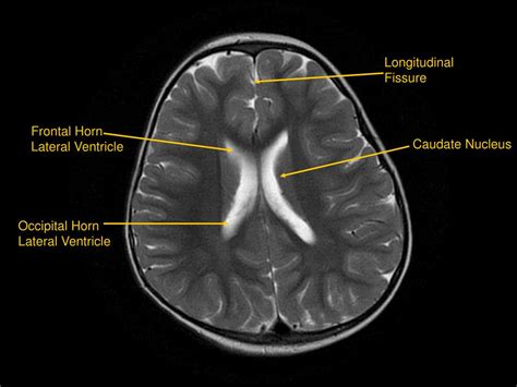 PPT - MRI of Brain/Head and Neck PowerPoint Presentation, free download ...