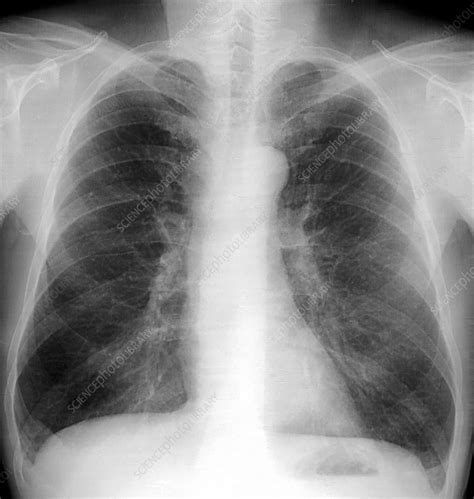 Smoker's lungs, X-ray - Stock Image C001/7637 - Science Photo Library