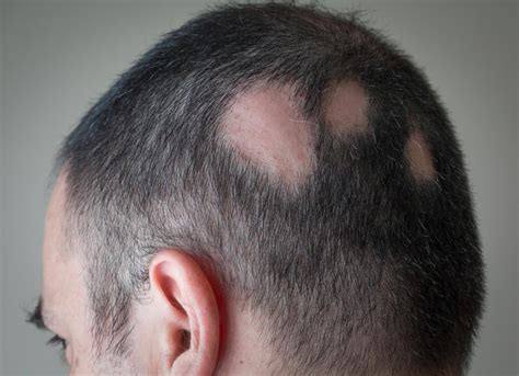 Alopecia areata: Symptoms, treatment, and tips