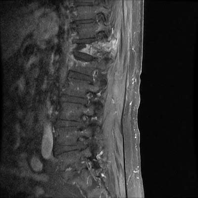 Radiology Cases: Chance Fracture I -- Initial MRI