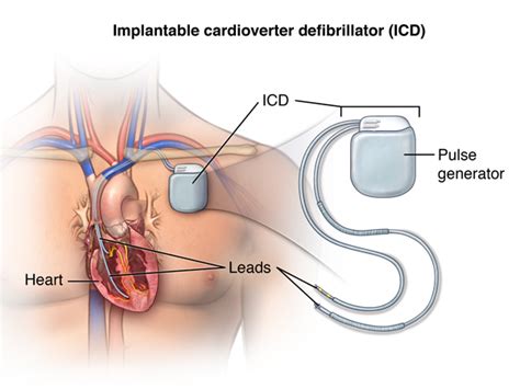 Implantable Cardioverter Defibrillator (ICD) - My Blog