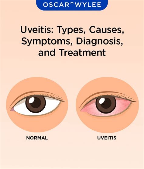 Uveitis: Types, Causes, Symptoms, Diagnosis, and Treatment