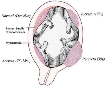 Placenta accreta spectrum - Wikipedia