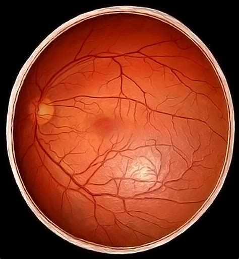 Types and Causes of Retinal Detachment - StoryMD