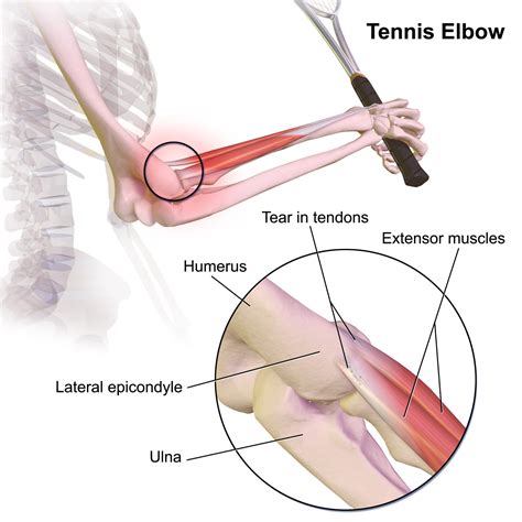 Tennis_Elbow - Advanced Orthopedic & Sports Medicine Specialists