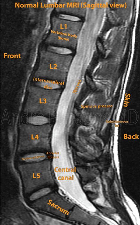 Healthcare Extreme How To Read An MRI Lumbar Spine In 8 Easy Steps ...