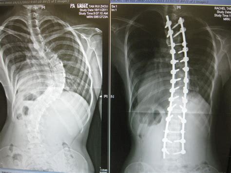 Before and After Major Scoliosis Surgery by hypnosisapple on DeviantArt