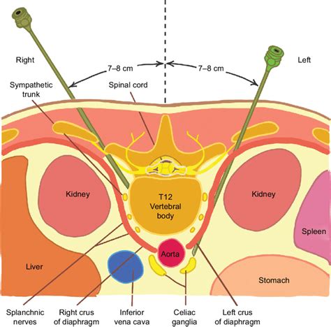 anatomy of percutaneous retrocrural neurolytic celiac plexus block ...