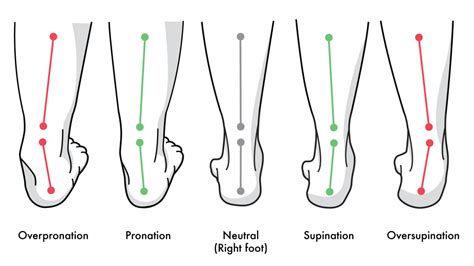 What is Pronation? Understanding Your Feet | Kintec: Footwear + Orthotics