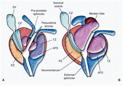 Cancer of the Prostate | Oncohema Key