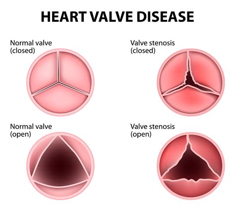 What Are Heart Valve Flaps? - Dr. Peter Mikhail