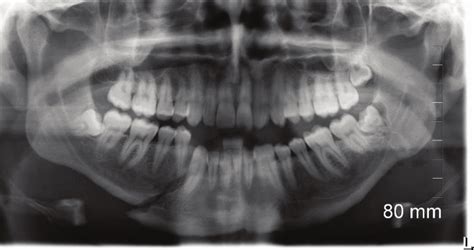 Mandibular Fracture X Ray