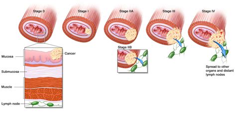 Pathology Outlines - Staging