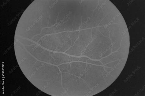 Fluorescein angiography of eye disease in the foreground Stock Photo ...