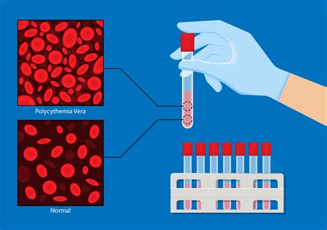 What Is Polycythemia Vera? | PV Reporter