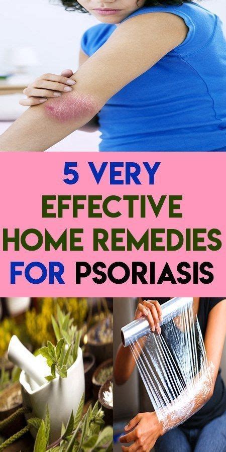 5 very effective home remedies for psoriasis - Keto Slim Reviews ...