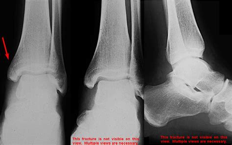 Isolated medial malleolus fracture