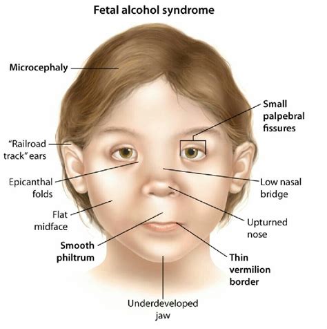 Fetal Alcohol Syndrome Causes, Symptoms And Diagnosis