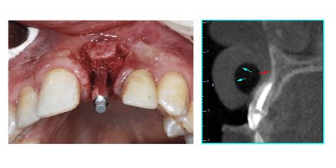 Maxillary Central Incisor Implant Supported Crown - Osstell®