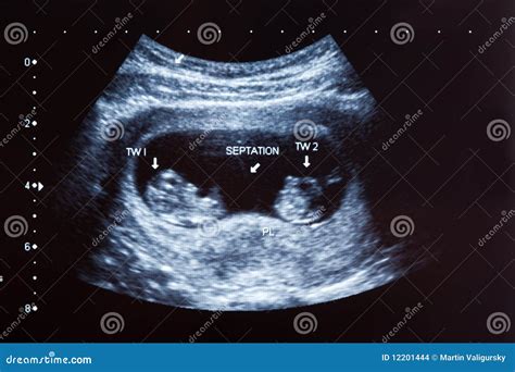 10 Week Ultrasound Pictures 2023