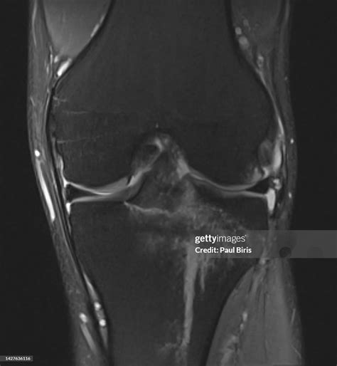 Anterior Cruciate Ligament Avulsion Fracture Or Tibial Eminence ...