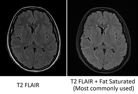 FLAIR MRI | FLAIR MRI Sequence Physics, Image and Pathology Appearance