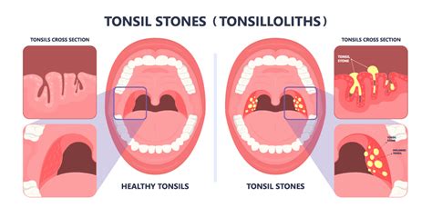 What Are Tonsil Stones? How Do I Get Rid Of Them?, 40% OFF