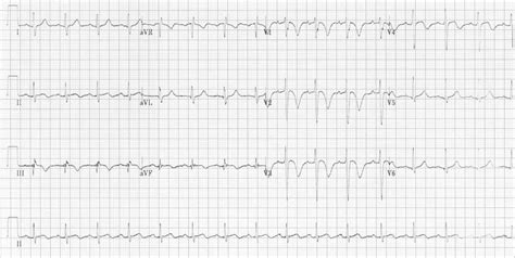 ECG changes in Pulmonary Embolism • LITFL • ECG Library