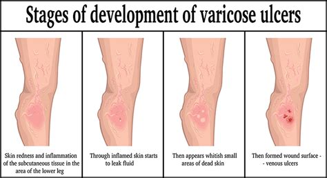 What are Venous Leg Ulcers: Advanced Vein Therapy