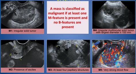 Would a regular ultrasound be able to differnciate a benign ovarian ...