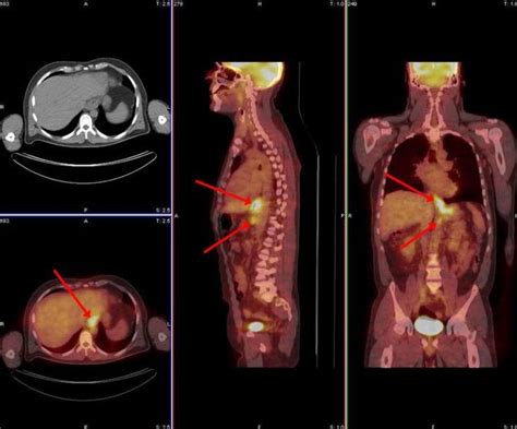 Pet Ct Scan Lymphoma - Petspare