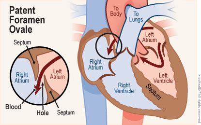 Patent Foramen Ovale (PFO) (for Parents) - Arkansas Children's