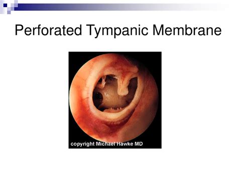 Perforated Tympanic Membrane Treatment