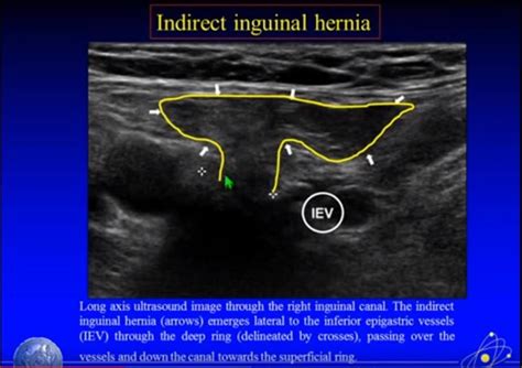 www.tomwademd.net ultrasound-imaging-of-hernia-parts-1-2-of-4-a-youtube ...