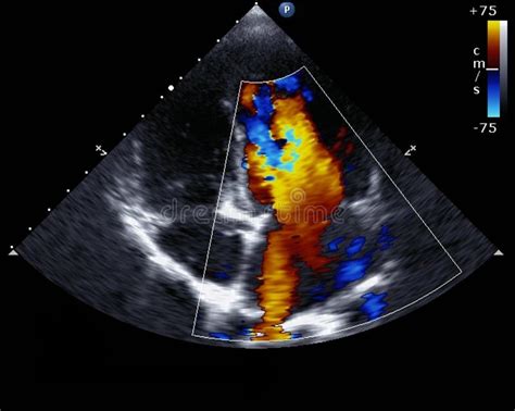 Doppler echocardiography stock image. Image of hypertension - 52734865