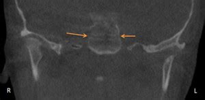 Anatomy Monday: Spheno-Occipital Synchondrosis – Dr. G's Toothpix