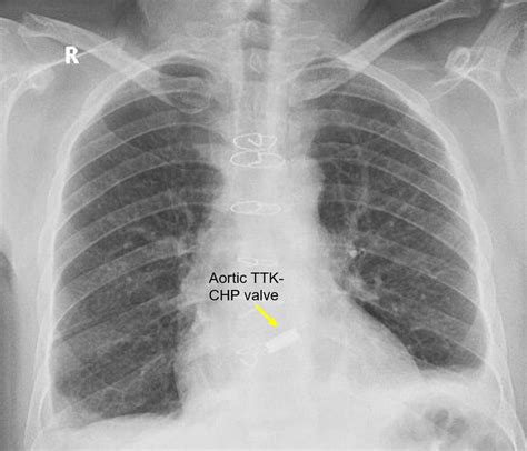 Prosthetic heart valves on CXR – All About Cardiovascular System and ...