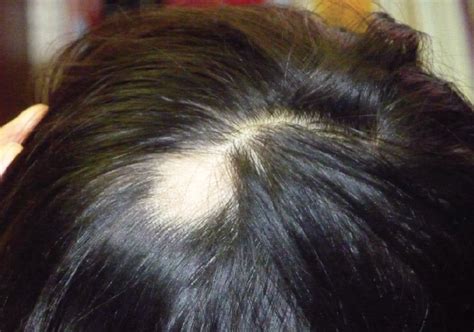 What is the cause of hair loss in this 11-year-old? | Consultant360