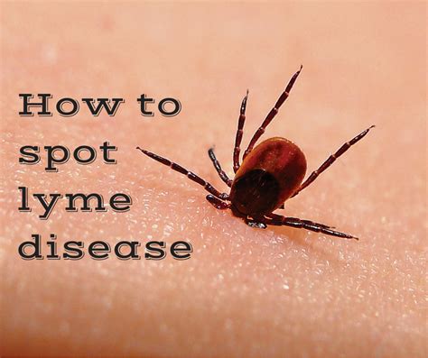 Ticks and Lyme Disease - Know The Symptoms of Lyme Disease | Lyme ...