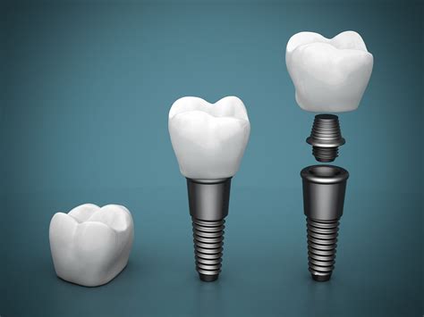 N Frisco TX, Frisco Oral And Dental Implant Surgery