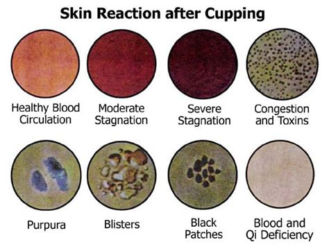 Cupping Color Chart - Why Does Cupping Leave Marks And What Are Their ...