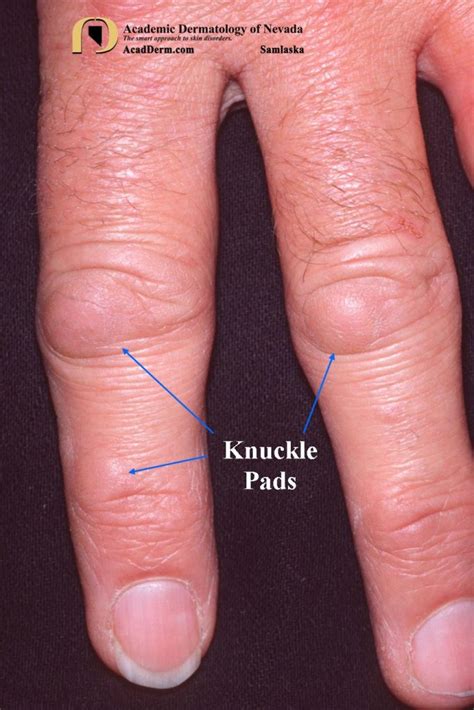 Knuckle Pads: Heloderma... - Academic Dermatology of Nevada