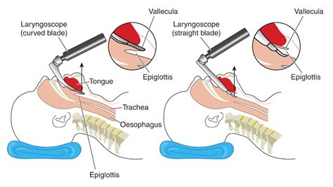 Intubation: Overview and Practice Questions